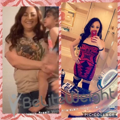 Weight Loss Surgery Before And After